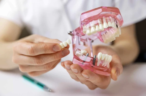 Bridge complet sur implant