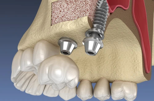 Sinus lift
