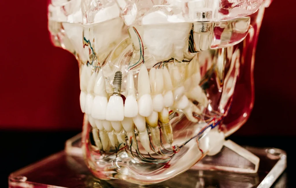 Implants dentaires dans le Morbihan