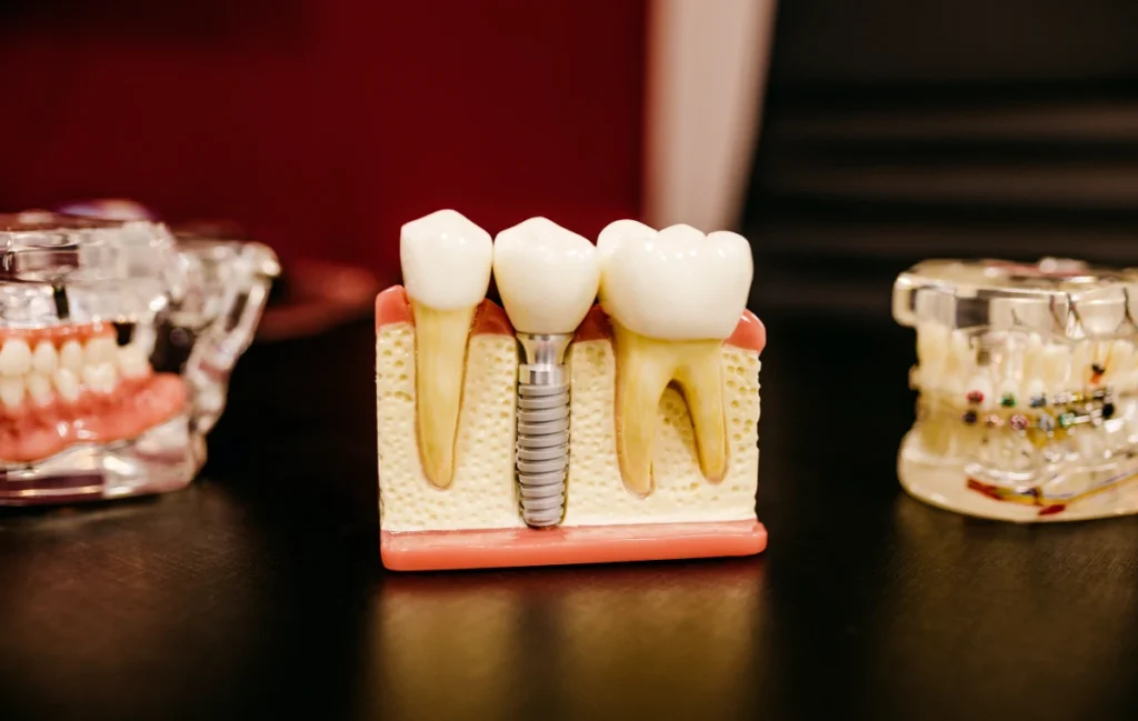 Implants dentaires à Vannes