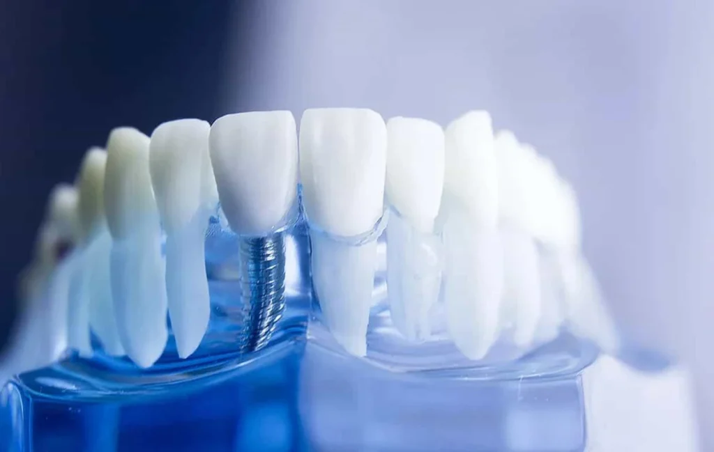Implants dentaires à Auray