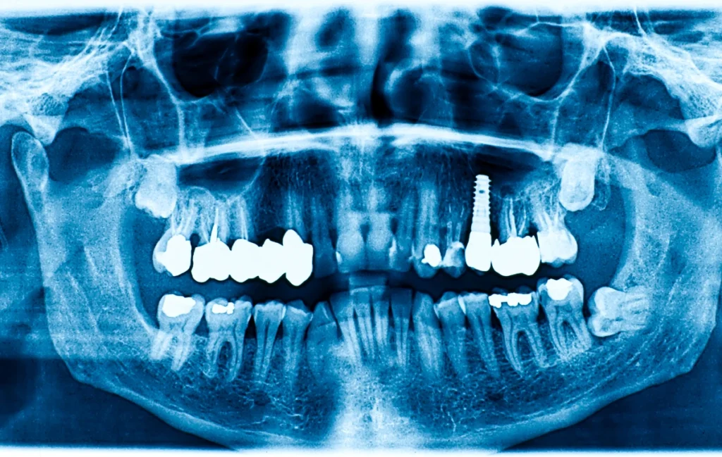 Implants dentaires dans le Morbihan