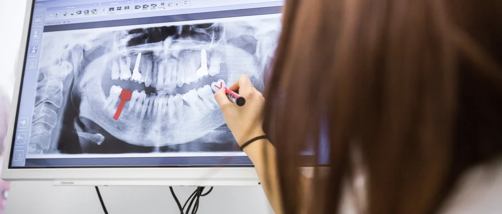 Pose d'implants et stress