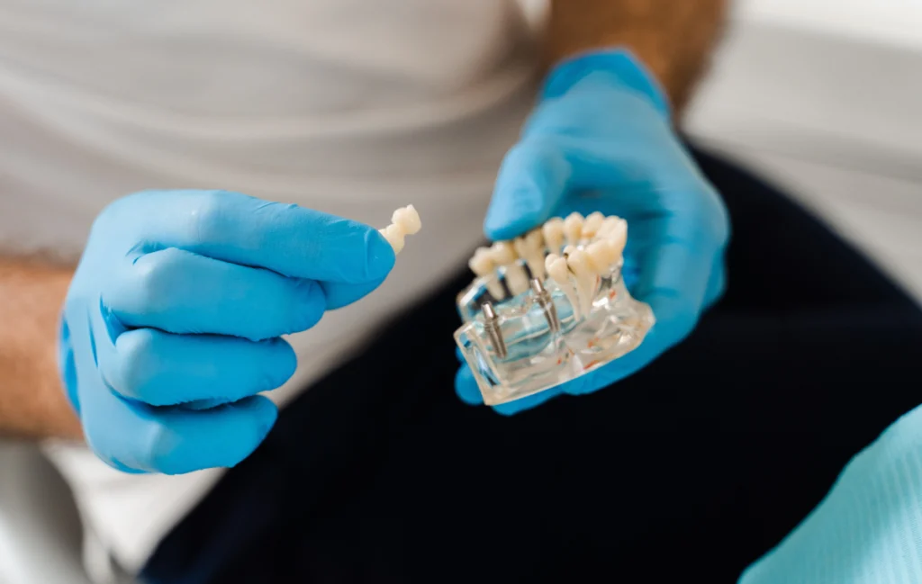 Bridge complet sur implant