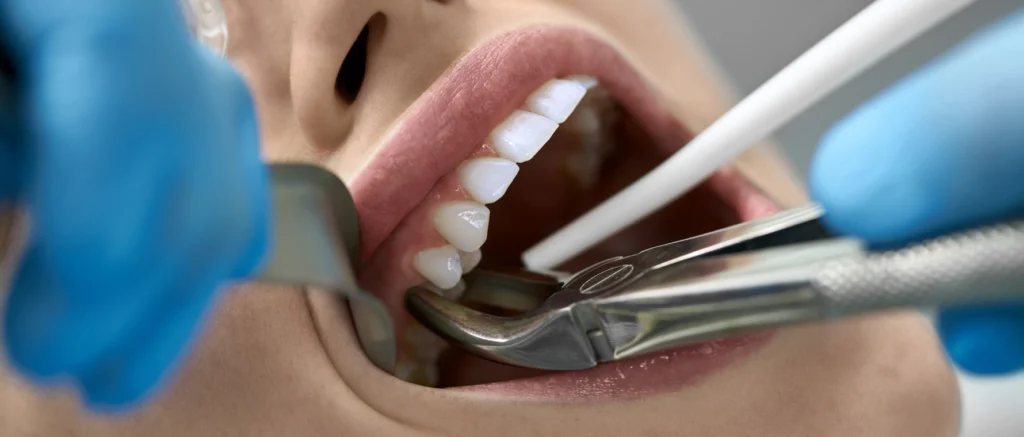 Extraction implantation immédiate