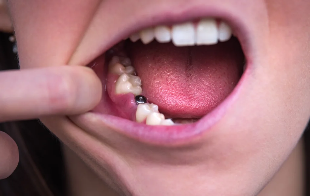 Implants dentaires et alimentation